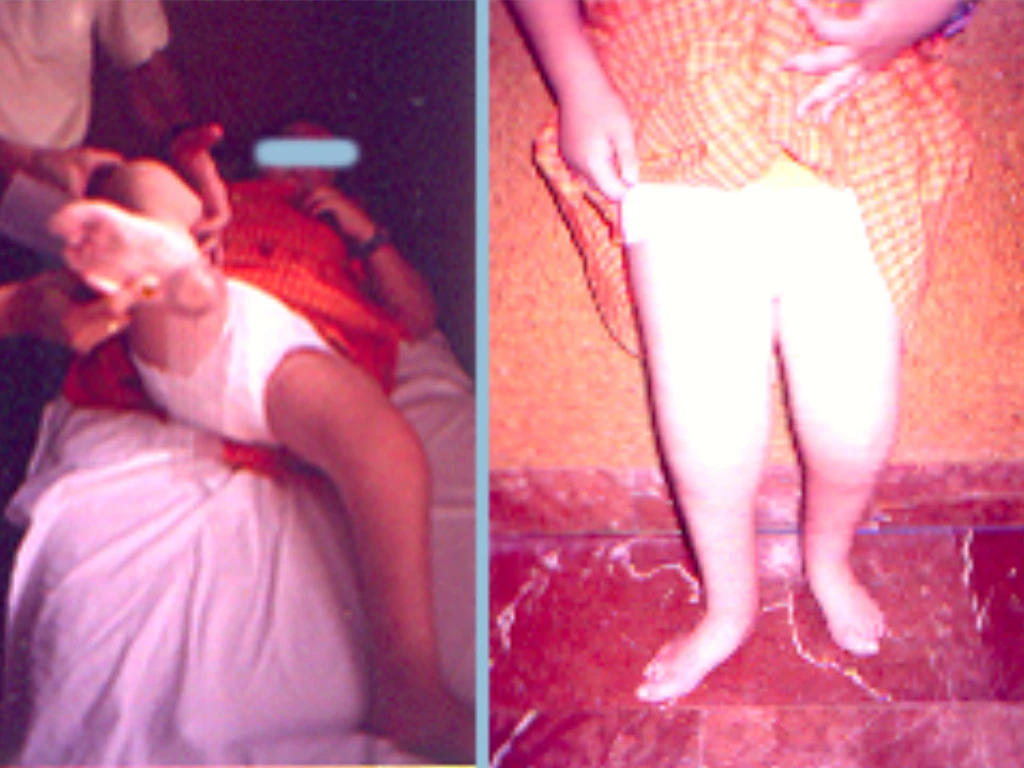 soporte-ortopedico-afecciones-neurologicas-infantiles