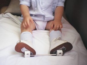 Eficacia del tratamiento con férula tipo INMOYBA en niños con torsión tibial interna y externa