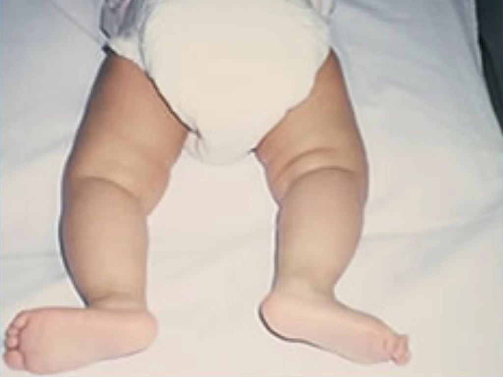 Derrotacion-Tibial férula ortopédica infantil