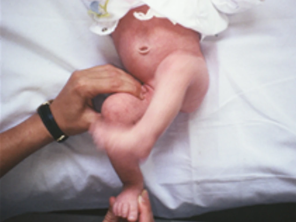 ferula-infantil-para-intrarrotacion-tibial